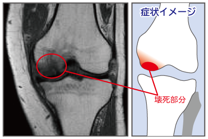 大腿 骨 壊死