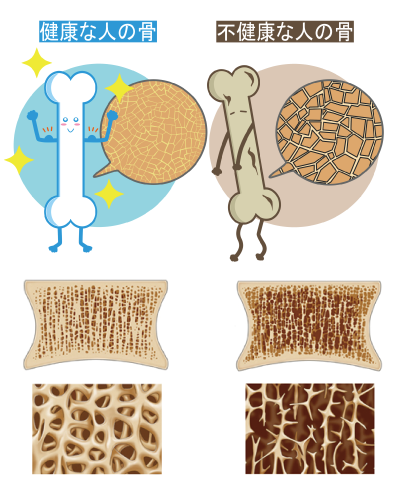 骨粗しょう症参考画像