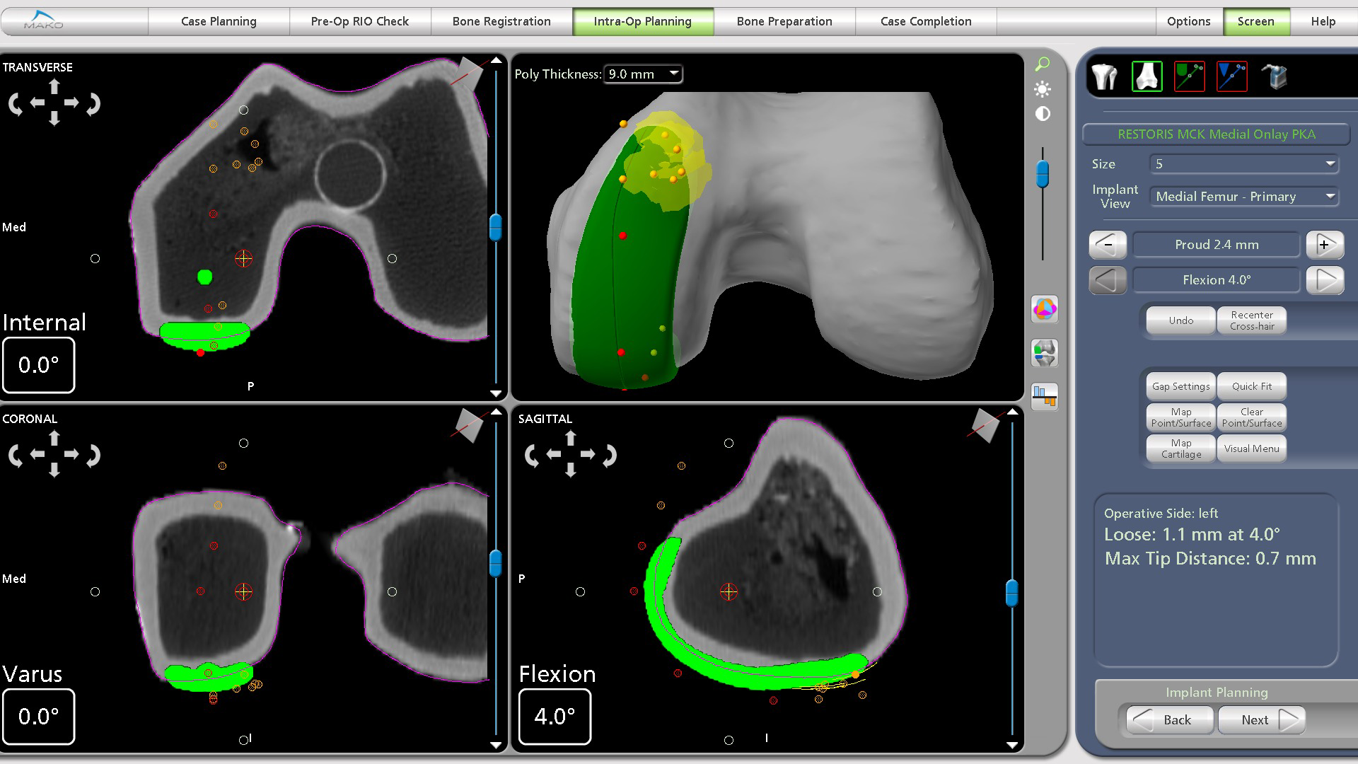 Mako Partial Knee cartilage mapping.png